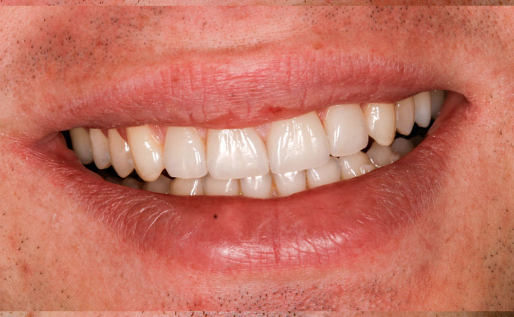 Mit Veneer