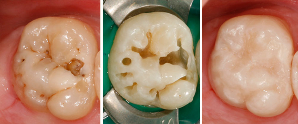 Minimalinvasive Zahnbehandlung