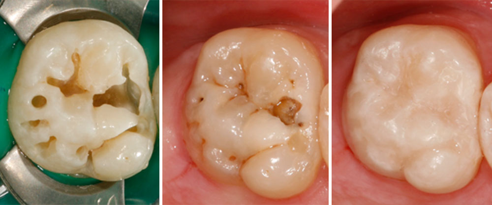 Minimalinvasive Zahnfüllung